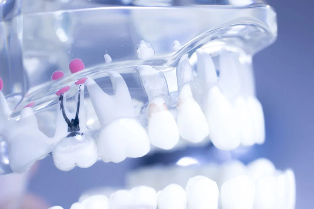 Wurzelkanalbehandlung bei Shekh Kilo & Kollegen in München